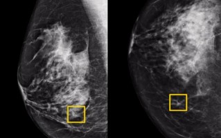谷歌AI检测乳腺癌准确率超人类医生